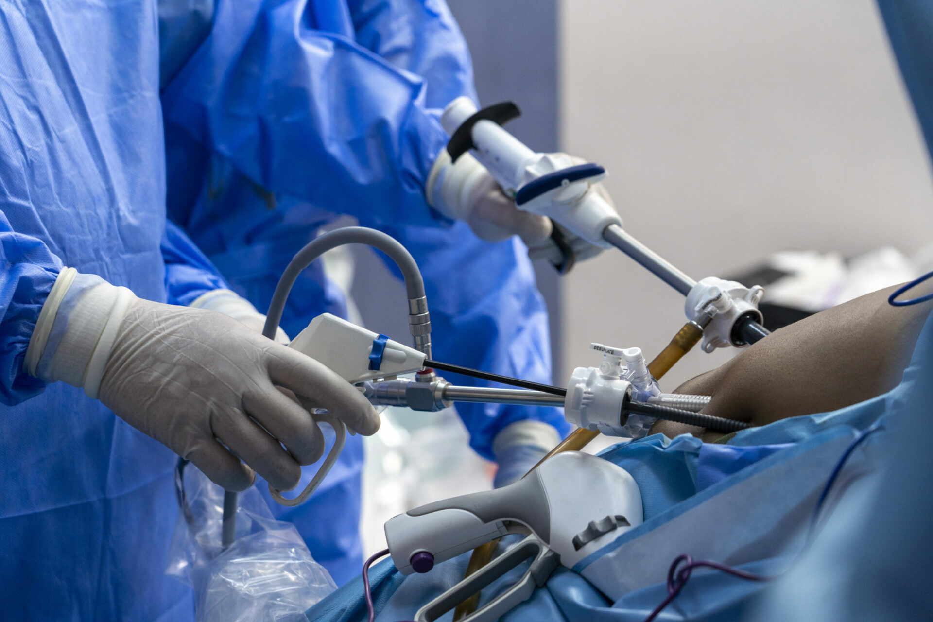 Cœlioscopie : colectomie mini-invasive par voie laparoscopique
