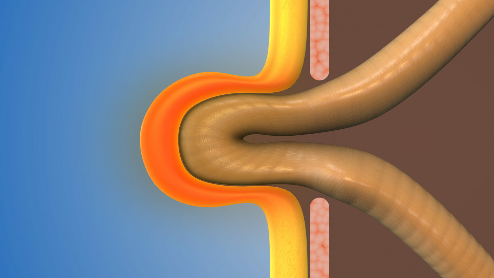 Représentation 3D d'une hernie inguinale au niveau de la paroi abdominale
