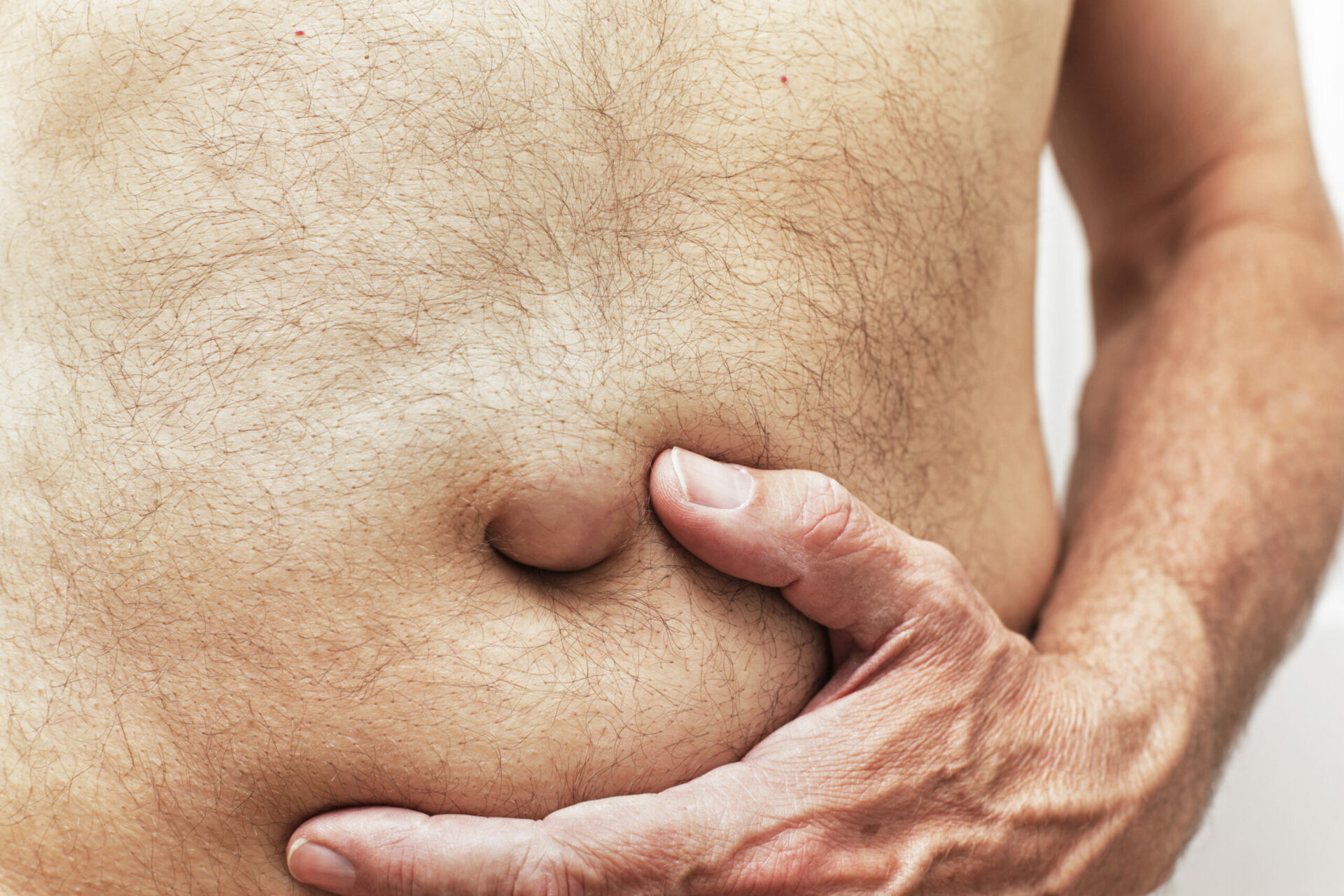 Hernie ombilicale visible chez un patient adulte