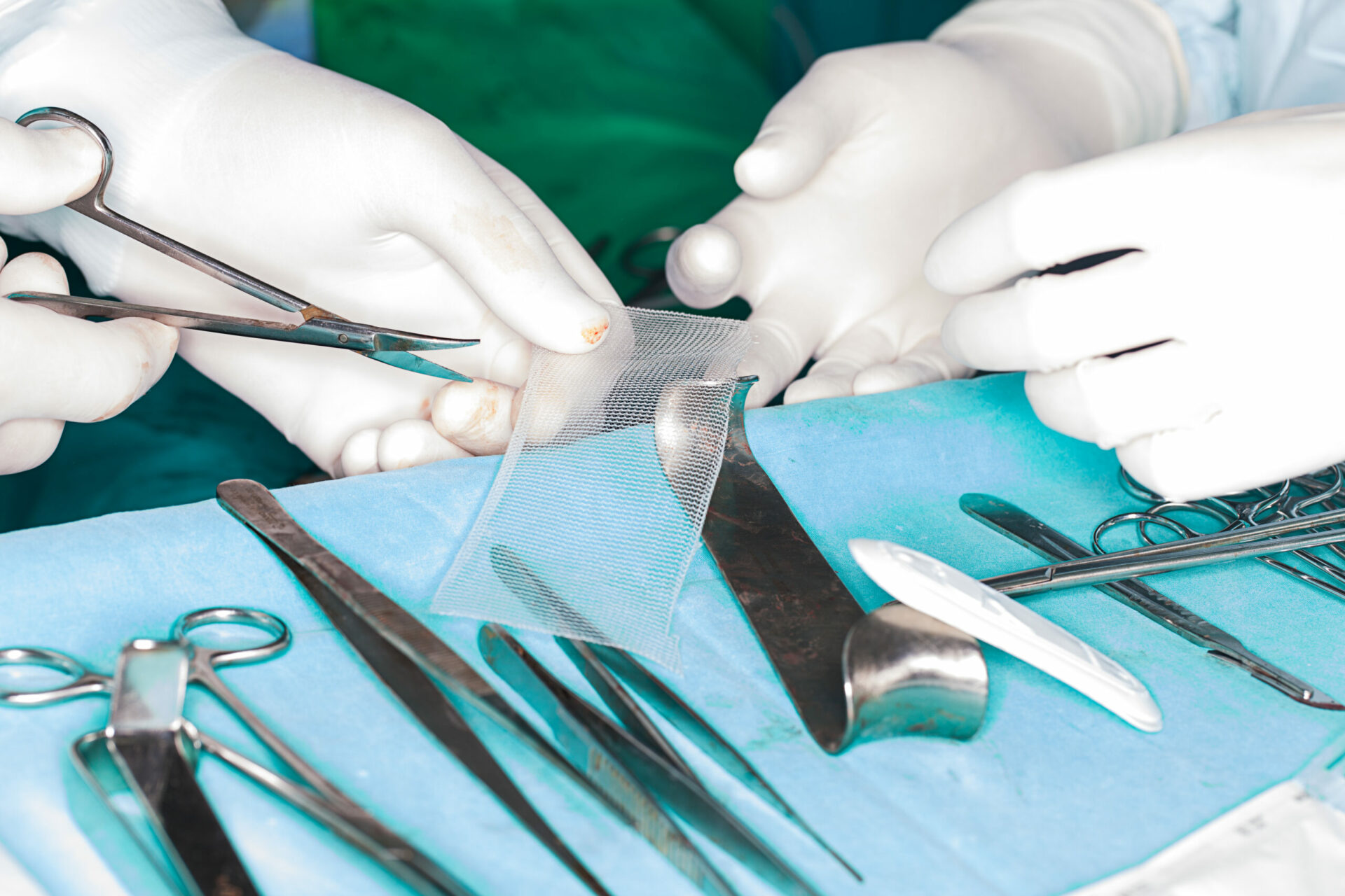 Prothèse en treillis (mesh) utilisée pour la cure de hernie
